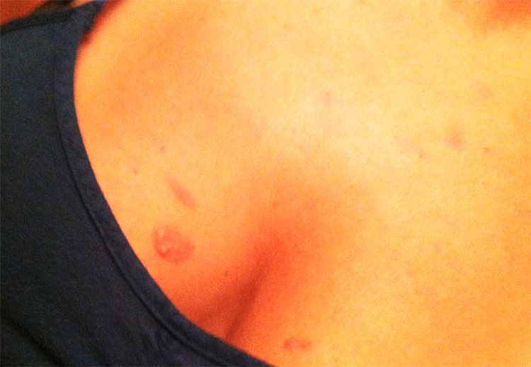 Burnt-Boobs-brass-burn Burnt-Boobs-brass-burn